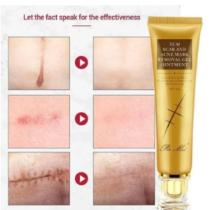 Scar And Acne Marks Removal